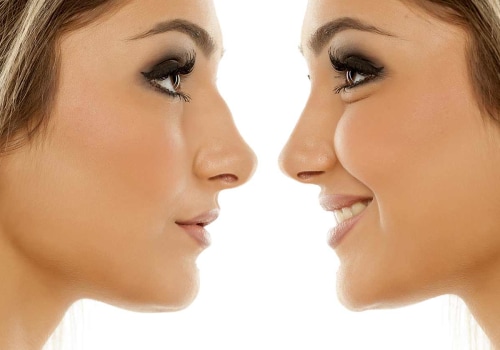 Perfect Nose: Best Rhinoplasty Surgeon in Beverly Hills